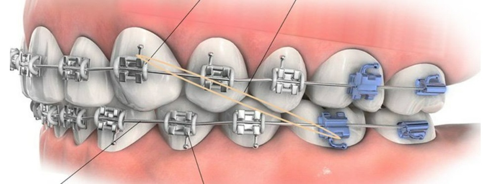 https://dantistclinic.com.ua/ortodontiya/metallicheskie-brekety/