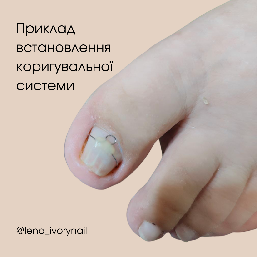 Приклад встановлення коригувальної системи від Олени Мазурак