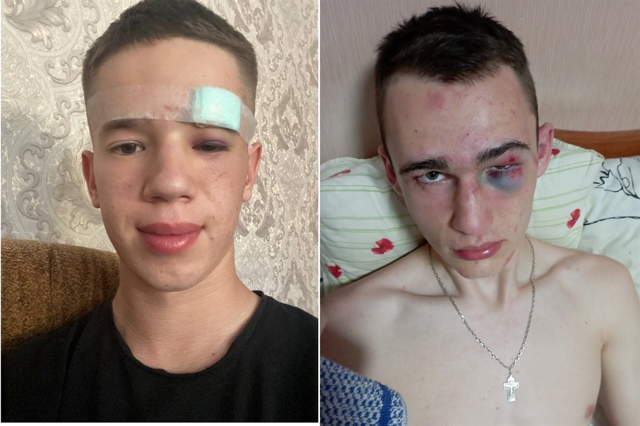 Так виглядав Олексій (праворуч на фото) після побиття. Ліворуч - його товариш, який намагався допомогти йому врятуватися від побоїв